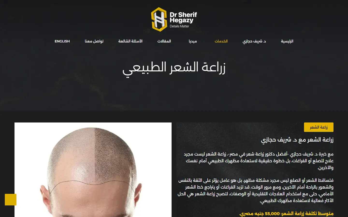 افضل دكتور في زراعة الشعر الطبيعي في مصر - دكتور شريف حجازي